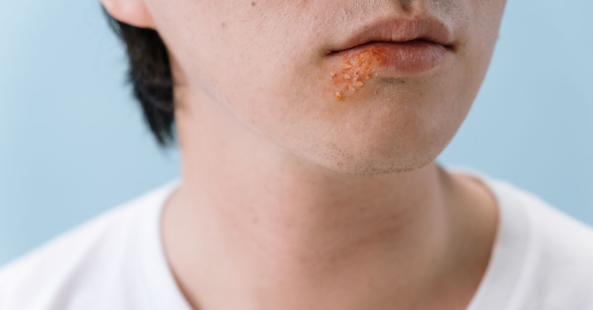 ringworm infection